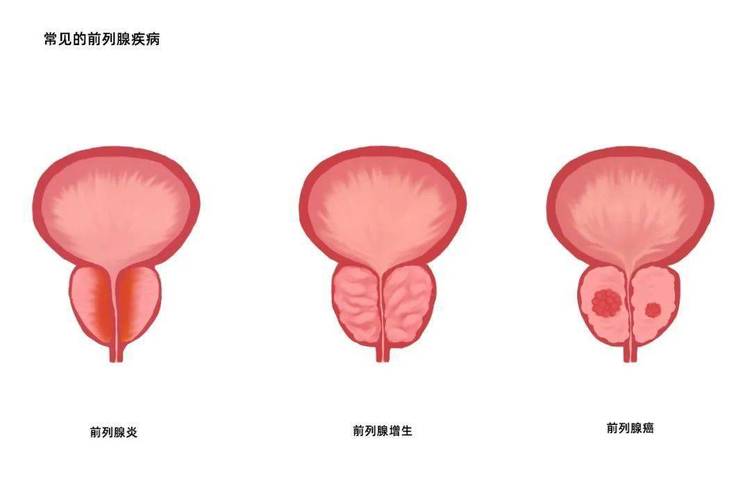 【紧急救援！】七旬老人的排尿危机，一招解决！